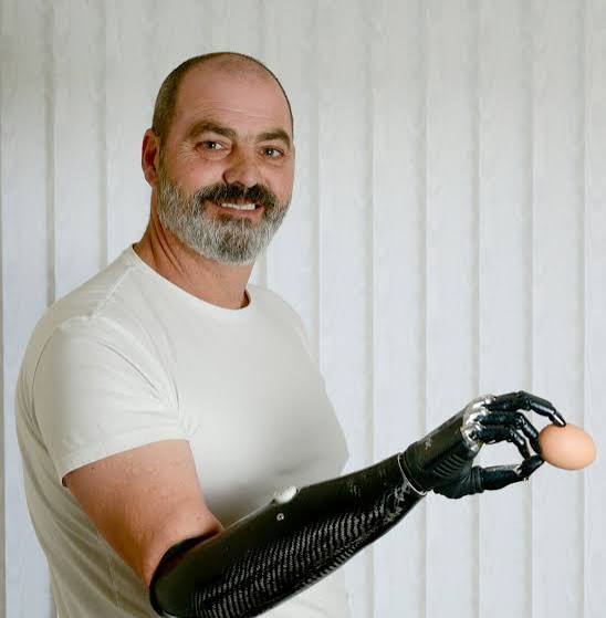 Nigel Ackland holding an egg with his black carbon-fiber bionic prosthetic hand